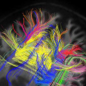 The wiggling motion of water molecules in the brain's nerve cells is captured by diffusion technology, revealing the pathways by which one part of the brain communicates with another.