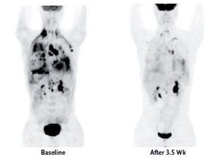 Tomographic scans taken at baseline (left) and after 3.5 weeks of ceritinib treatment (right) in a patient with crizotinib-resistant disease.