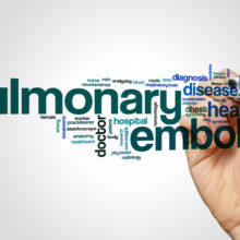 Pulmonary embolism is a dangerous condition that affects an estimated 800,000 Americans annually and kills about a quarter of them.