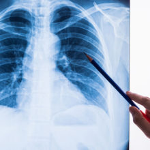 At Mass General, a new tool has been trained to compare chest x-ray results with subjects' survival rates over a 12-year period.