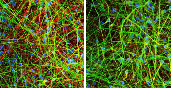 On the left, a cell culture taken from a patient with dementia, with the mutant tau highlighted in red. On the right, the same culture after treatment. 