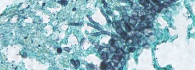 Transplant Infectious Disease